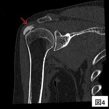 石灰沈着性腱板炎とは