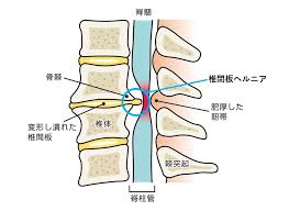 頚椎椎間板ヘルニアとは