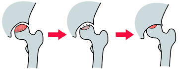 特発性大腿骨頭壊死症